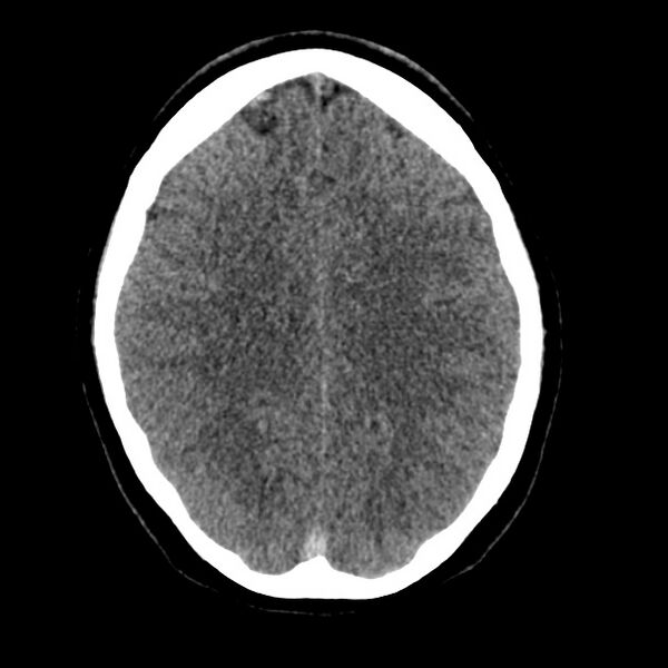 File:Cerebral venous sinus thrombosis (Radiopaedia 59224-66551 Axial non-contrast 28).jpg