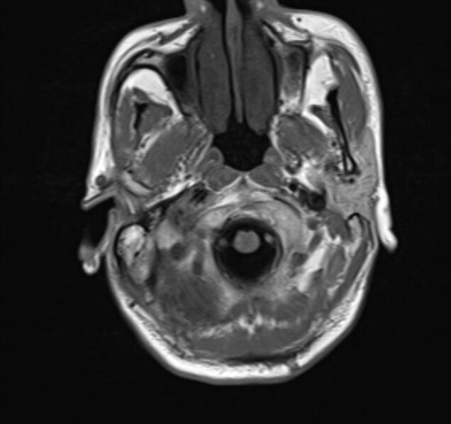 File:Cerebral venous thrombosis (Radiopaedia 71207-81504 Axial T1 3).jpg