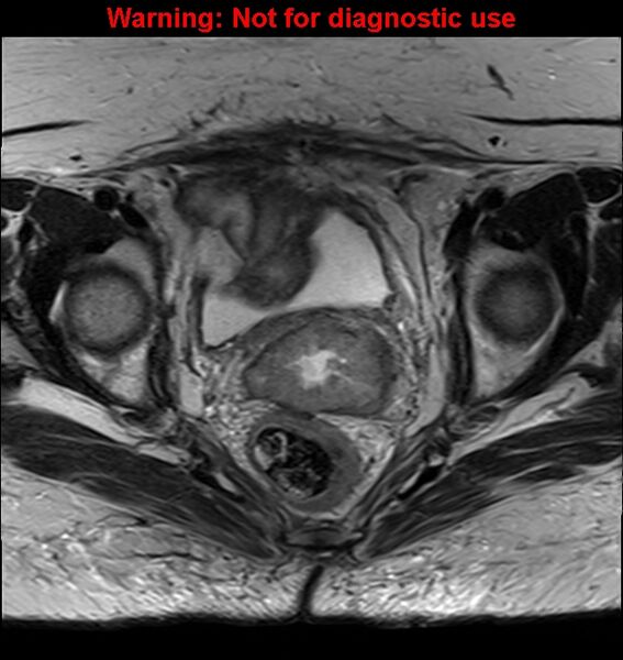 File:Cervical cancer (Radiopaedia 24151-24410 Axial T2 19).jpg