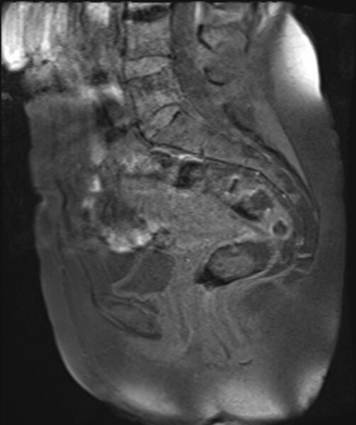 File:Cervical carcinoma (Radiopaedia 88312-104943 Sagittal T1 fat sat 16).jpg