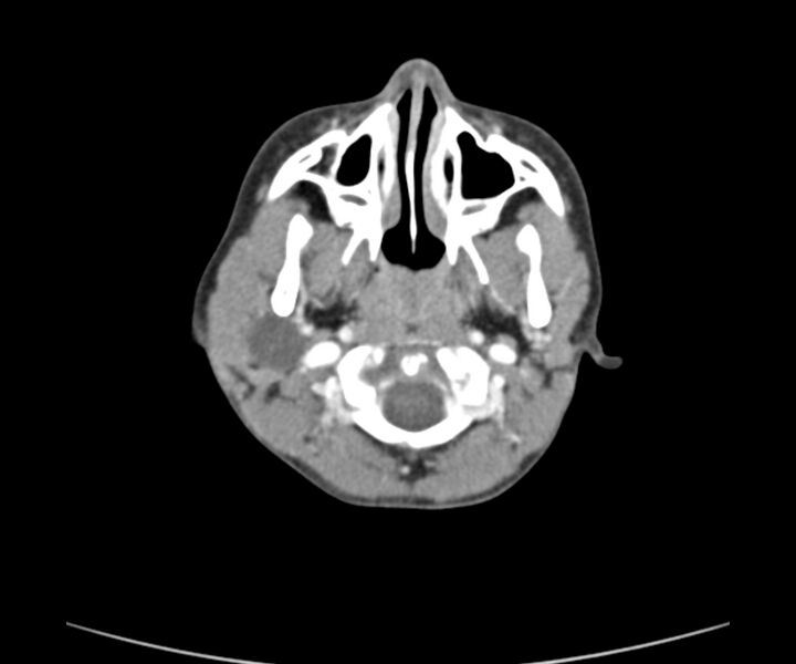 File:Cervical cystic lymphangioma (Radiopaedia 63655-72332 Axial + contrast 5).jpg