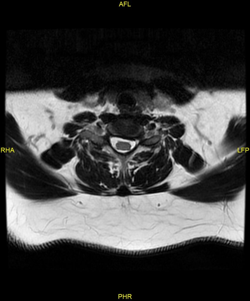 Cervical disc protrusion (Radiopaedia 87147-103415 Axial T2 54).jpg