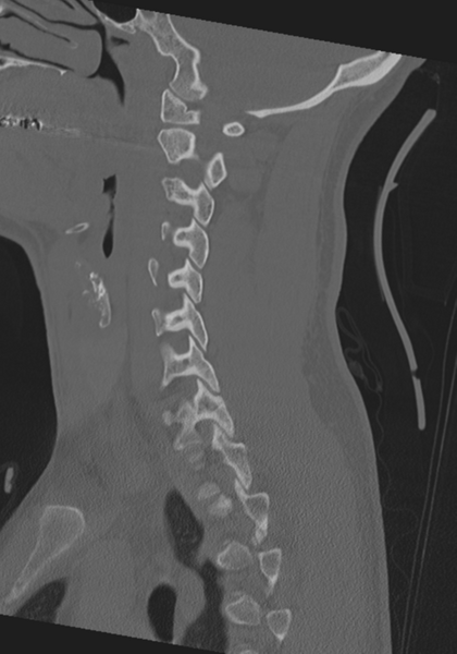 File:Cervical intercalary bone (Radiopaedia 35211-36748 Sagittal bone window 50).png