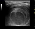 Cervical region pseudoaneurysm (Radiopaedia 34882).jpg