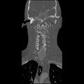 Cervical spine fractures with vertebral artery dissection (Radiopaedia 32135-33078 Coronal bone window 10).jpg