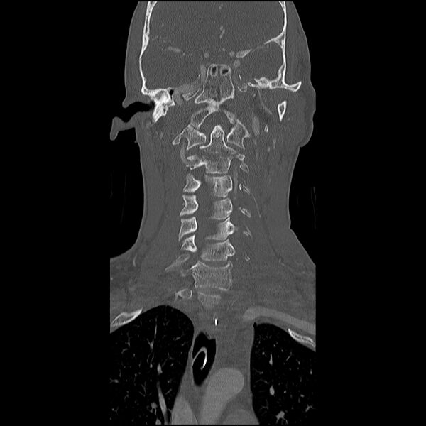 File:Cervical spine fractures with vertebral artery dissection (Radiopaedia 32135-33078 Coronal bone window 10).jpg