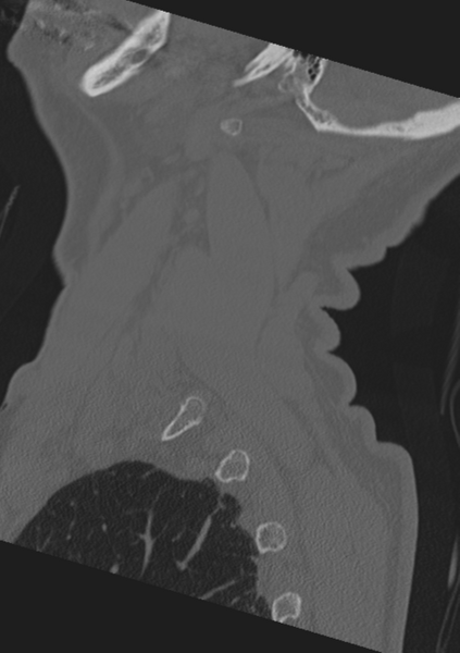 File:Cervical spine fractures with vertebral artery dissection (Radiopaedia 53296-59268 Sagittal bone window 5).png