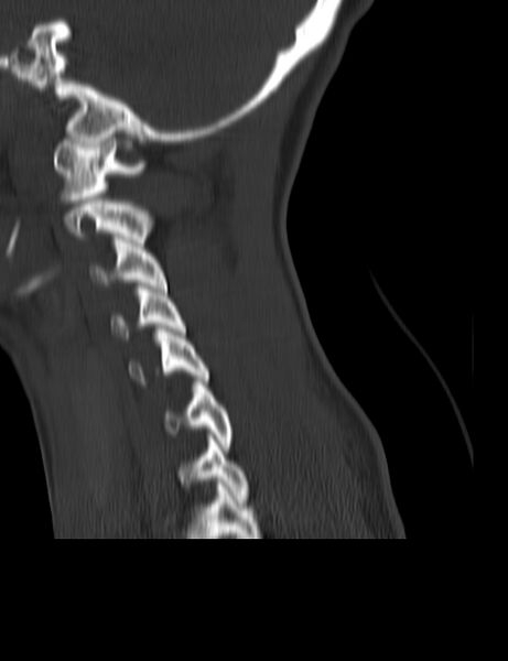 File:Cervical spine posterior ligamentous complex rupture (Radiopaedia 63486-72101 Sagittal bone window 5).jpg
