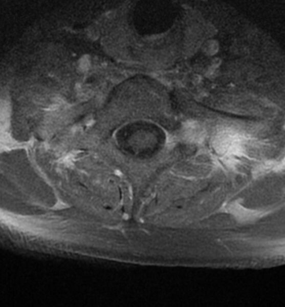 File:Cervical spondylodiscitis (Radiopaedia 81362-95110 Axial T1 C+ fat sat 17).jpg