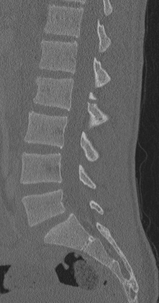 File:Chance fracture (Radiopaedia 40360-42912 Sagittal bone window 49).png
