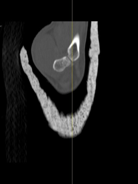File:Chauffeur's (Hutchinson) fracture (Radiopaedia 58043-65079 Sagittal bone window 21).jpg
