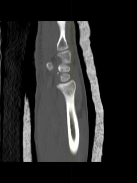 File:Chauffeur's (Hutchinson) fracture (Radiopaedia 58043-65079 Sagittal bone window 3).jpg