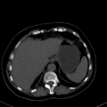 Cholecystitis - CT IVC obstructive choledocholitiasis (Radiopaedia 43966-47479 C 20).png