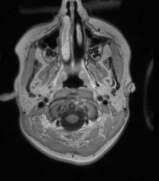 File:Choroid plexus carcinoma (Radiopaedia 91013-108553 Axial T1 C+ 67).jpg