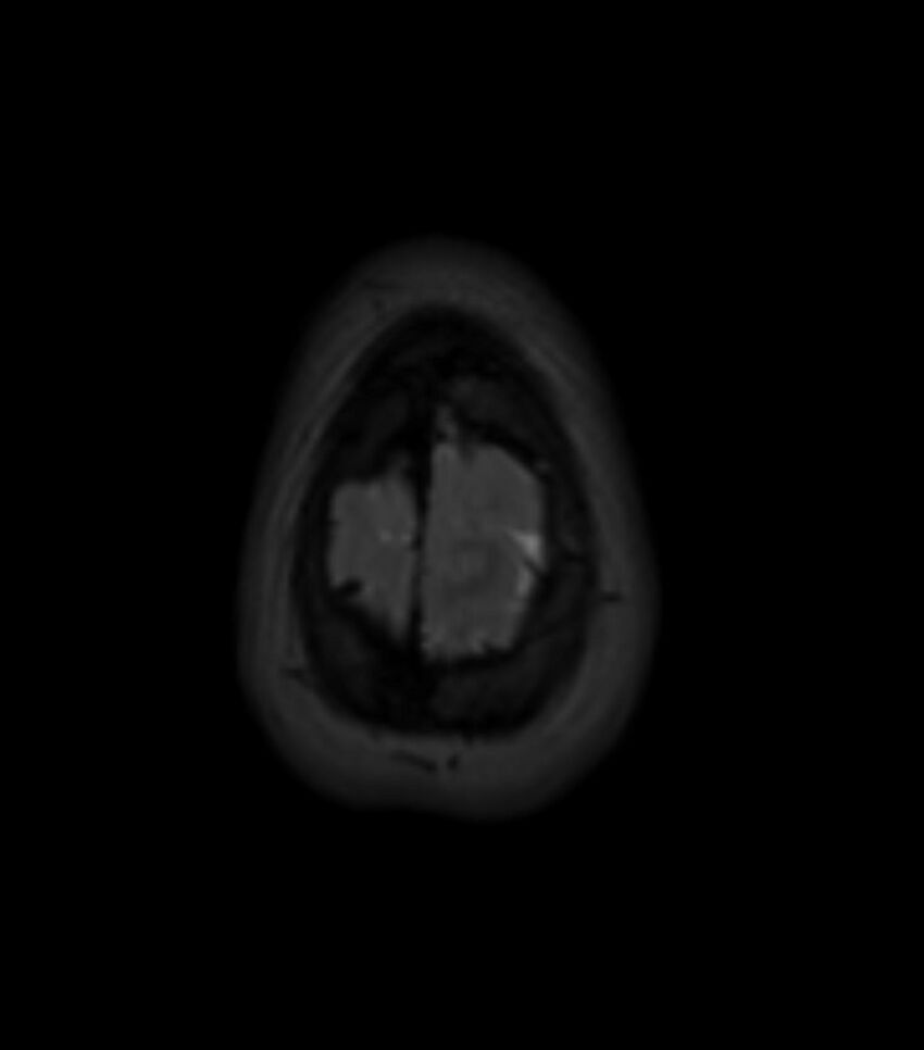 Choroid plexus carcinoma (Radiopaedia 91013-108553 Axial T2 fat sat 153).jpg