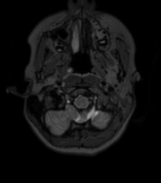 File:Choroid plexus carcinoma (Radiopaedia 91013-108553 Axial T2 fat sat 30).jpg