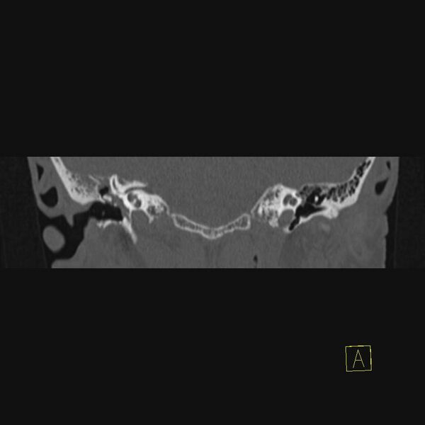File:Chronic otitis media (Radiopaedia 14994-14912 Coronal bone window 12).JPEG