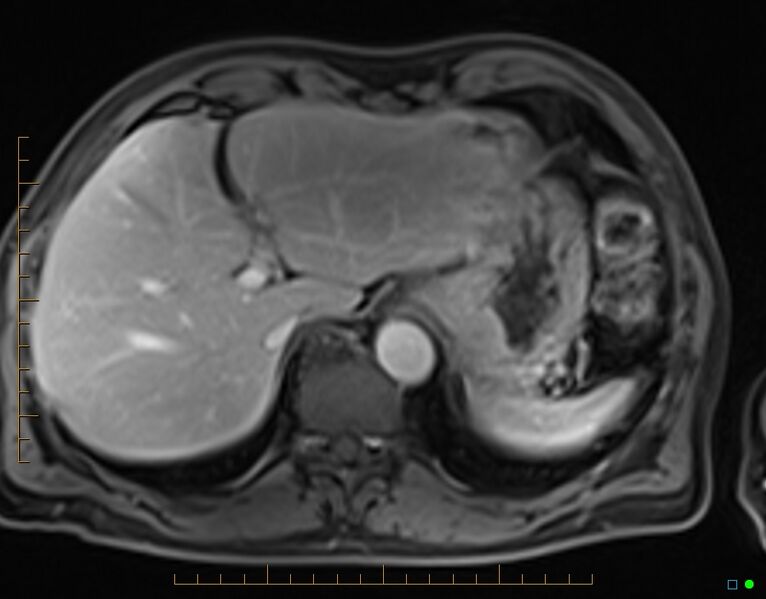 File:Chronic pancreatitis (Radiopaedia 17014-16716 Axial T1 C+ fat sat 10).jpg