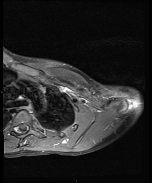 File:Chronic reactive multifocal osteomyelitis (CRMO) - clavicle (Radiopaedia 56406-63114 Axial T1 C+ fat sat 10).jpg