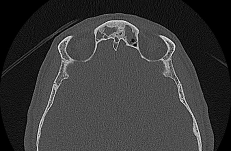 File:Chronic rhinosinusitis (Radiopaedia 65079-74075 Axial bone window 70).jpg
