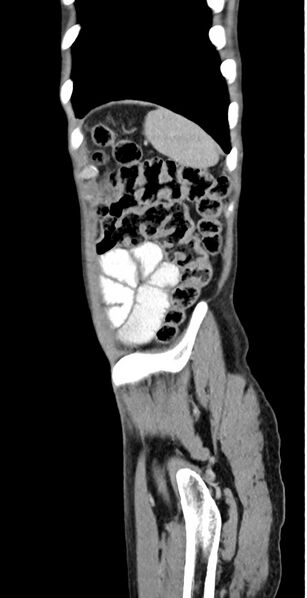 File:Chronic small bowel volvulus (Radiopaedia 75224-86322 C 25).jpg