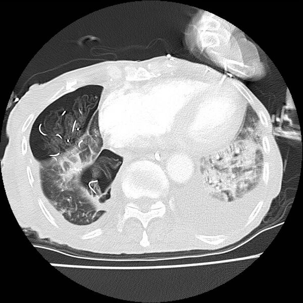 File:Clagett thoracotomy with bronchopleural fistula (Radiopaedia 29192-29587 Axial lung window 37).jpg