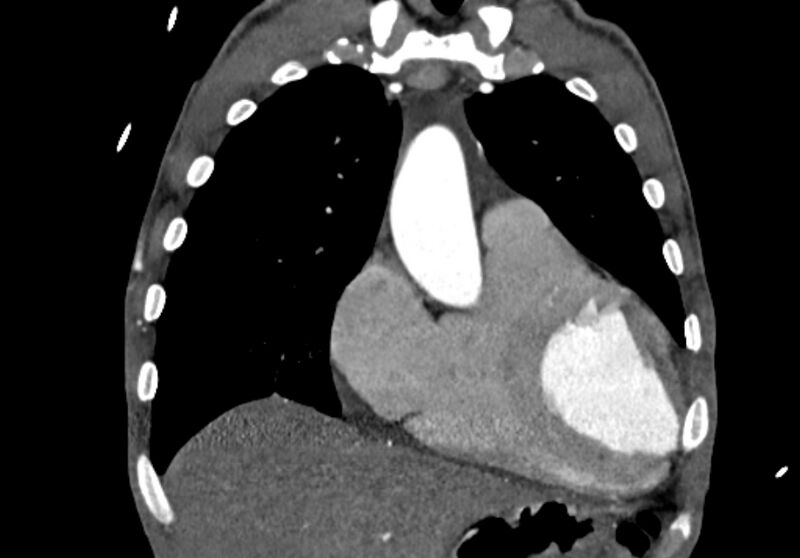 File:Coarctation of aorta with aortic valve stenosis (Radiopaedia 70463-80574 C 52).jpg