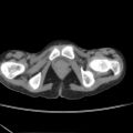 Colocolic fistula - Crohn disease (Radiopaedia 57063-63955 A 95).jpg