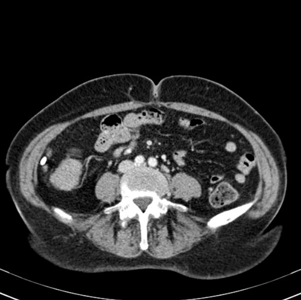 File:Colon carcinoma with hepatic metastases (Radiopaedia 29477-29961 A 69).jpg