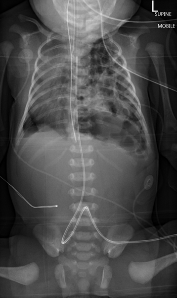 File:Congenital diaphragmatic hernia (Radiopaedia 41002).png