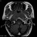Nasopharyngeal carcinoma (Radiopaedia 4546-6667 Axial T1 9).jpg