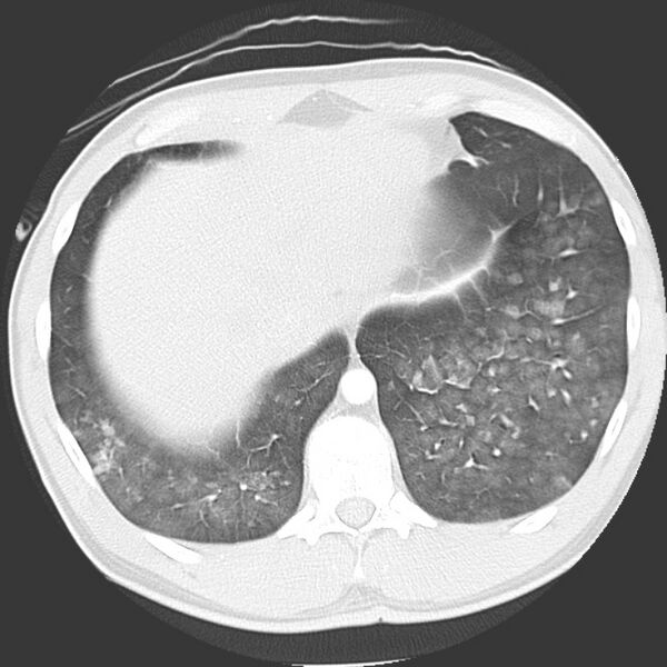 File:Near drowning pulmonary edema (Radiopaedia 16868-16591 Axial lung window 45).jpg
