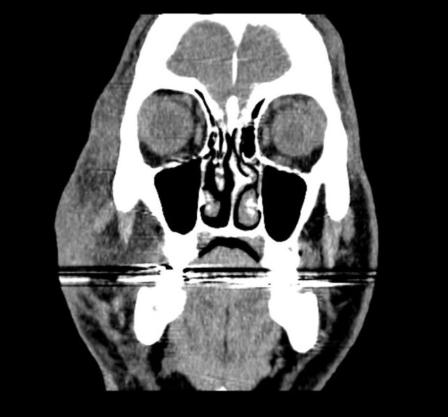 File:Necrobiotic xanthogranuloma- face (Radiopaedia 29549-30052 A 6).jpg