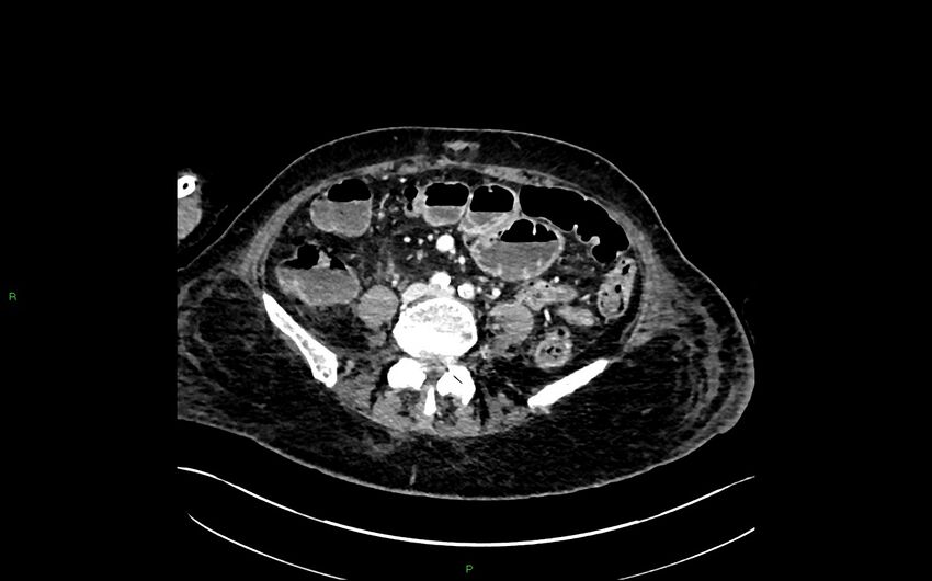 Neo-terminal ileal stricture (Crohn disease) (Radiopaedia 33790-34948 A 279).jpg