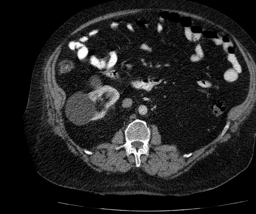 Nephroptosis with inguinal hernia containing perirenal fat (Radiopaedia 56632-63391 C 159).jpg