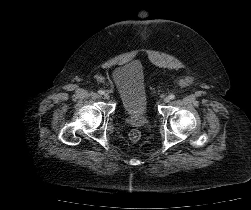 Nephroptosis with inguinal hernia containing perirenal fat (Radiopaedia 56632-63391 C 312).jpg