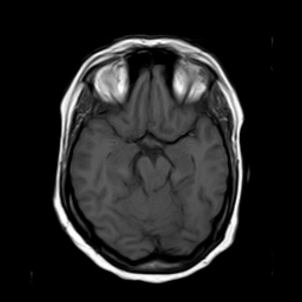File:Neurofibromatosis type 2 (Radiopaedia 67470-76871 Axial T1 9).jpg