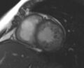 Non-compaction of the left ventricle (Radiopaedia 69436-79314 Short axis cine 121).jpg