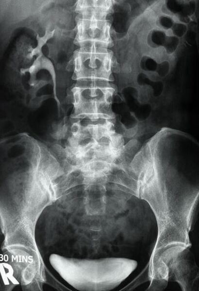 File:Non-functioning kidney on intravenous urography (Radiopaedia 22970-23000 D 1).jpg