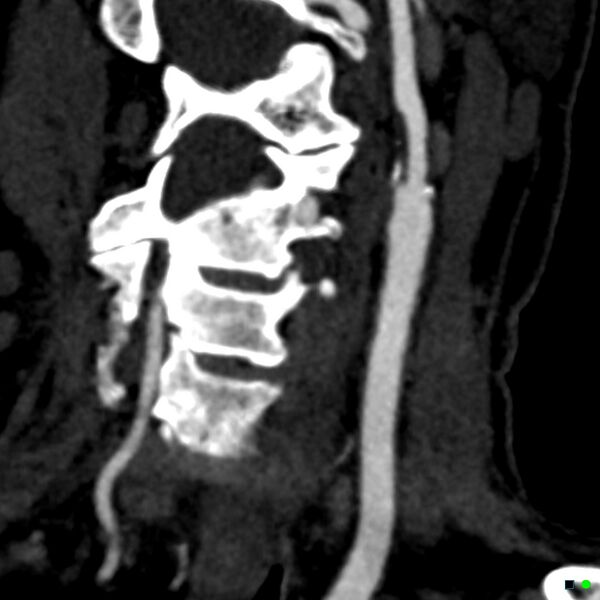 File:Non-occlusive intraluminal internal carotid artery thrombus (Radiopaedia 37751-39658 C 4).jpg