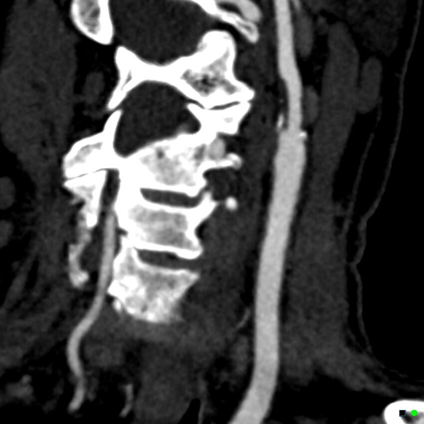 Non-occlusive intraluminal internal carotid artery thrombus (Radiopaedia 37751-39658 C 4).jpg