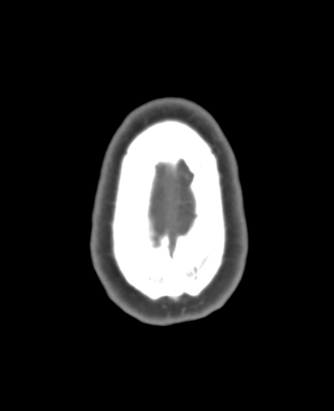 File:Normal CTA head (Radiopaedia 40801-43464 A 10).png