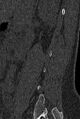 Normal CT lumbar spine (Radiopaedia 53981-60118 Sagittal bone window 82).jpg