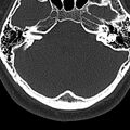 Normal CT of the cervical spine (Radiopaedia 53322-59305 Axial bone window 3).jpg