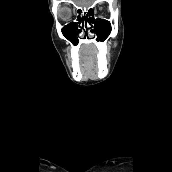 File:Normal CT of the neck (Radiopaedia 14575-14500 Coronal C+ 9).jpg