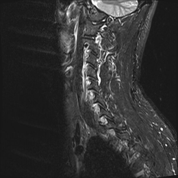 File:Normal cervical spine MRI (Radiopaedia 38418-40496 Sagittal STIR 12).jpg