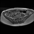 Normal female pelvis MRI (retroverted uterus) (Radiopaedia 61832-69933 Axial T1 4).jpg
