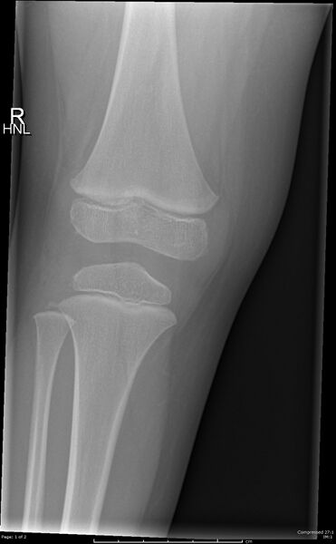 File:Normal knee x-ray - 4-year-old (Radiopaedia 58095-65143 B 1).jpg