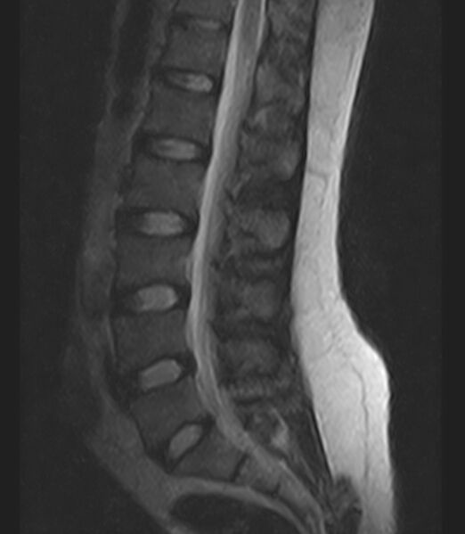 File:Normal lumbar spine MRI - low-field MRI scanner (Radiopaedia 40976-43699 Sagittal T2 7).jpg