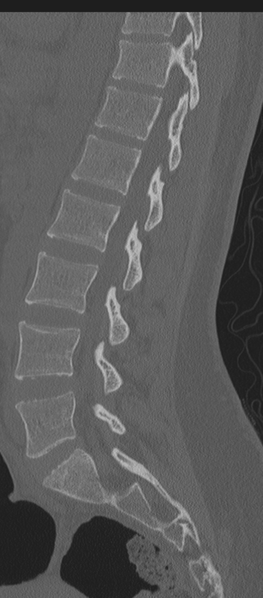 File:Normal lumbosacral CT (Radiopaedia 37923-39867 Sagittal bone window 43).png